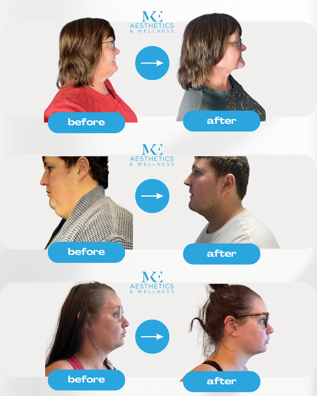 Before and after chin and neck liposuction results showing three patients treated by Dr. Kenneth Byom at MKE Aesthetics